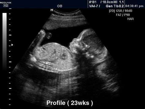 MEDISON.RU - Fetus, 23 weeks (№296, Accuvix-XQ)