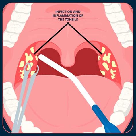 Best tonsil removal (tonsillectomy) Surgery & Treatment in Amanora Park ...