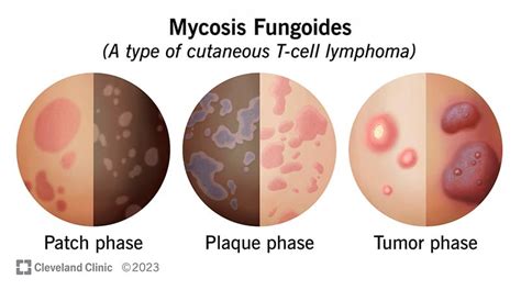 Mycosis Fungoides: Symptoms and Treatment