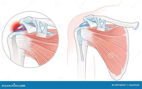 Rotator Cuff Bursitis Shoulder Illustration Labeled Stock Illustration ...