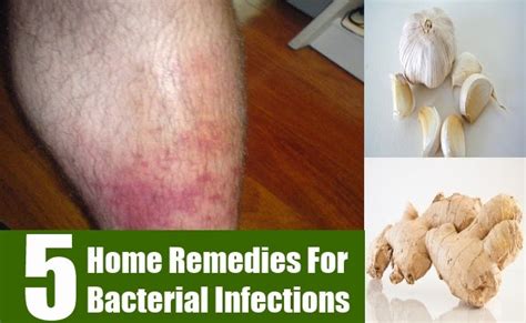 5 HOME REMEDIES FOR BACTERIAL INFECTIONS ~ Mzizi Mkavu