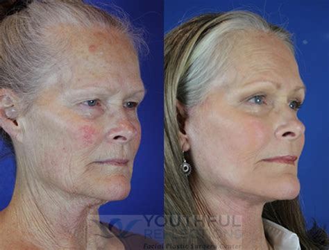 Laser Skin Resurfacing Before And After - 02/2022