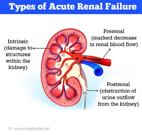 Acute Renal (Kidney) Failure- Causes, Symptoms, Diagnosis, Treatment ...