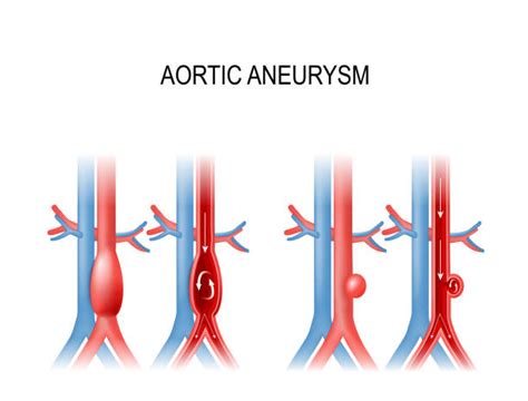 Abdominal Aorta Anatomy