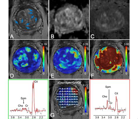 Multiparametric MRI of the prostate of a 68-year-old man with a serum ...