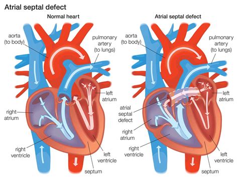 Atrial Septal Defect (ASD) Explained