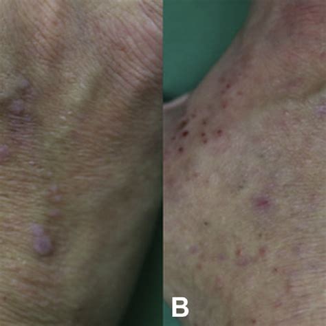 Lichenoid eruption. A, At week 16 of treatment, localized flat-topped ...