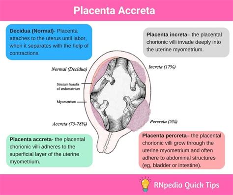 Placenta Accreta Nursing Management - RNpedia | Child nursing ...