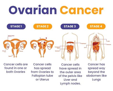 Affordable Cost Ovarian Cancer Treatment in Ludhiana, Punjab