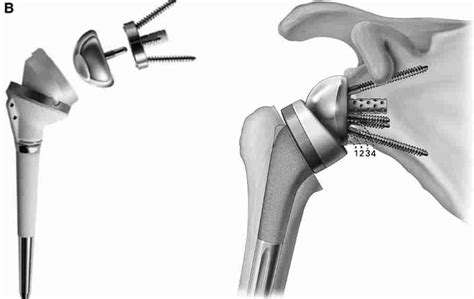 A Guide to Reverse Shoulder Replacement Surgery & Recovery