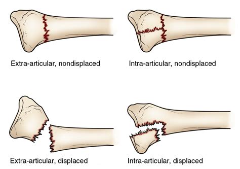 Distal Radius Fractures (Broken Wrist) - OrthoInfo - AAOS