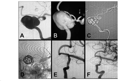 | A large aneurysm in the clinoid and ophthalmic segment of the ...