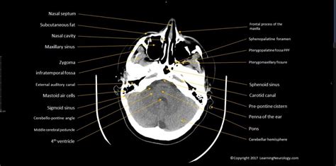 Approach to CT head | LearningNeurology.com