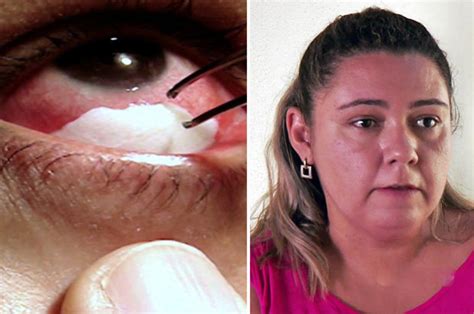 Woman who cries crystal tears pulls 30 membranes out every day | Daily Star