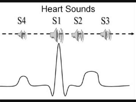 What Causes An S4 Heart Sound - slidesharetrick