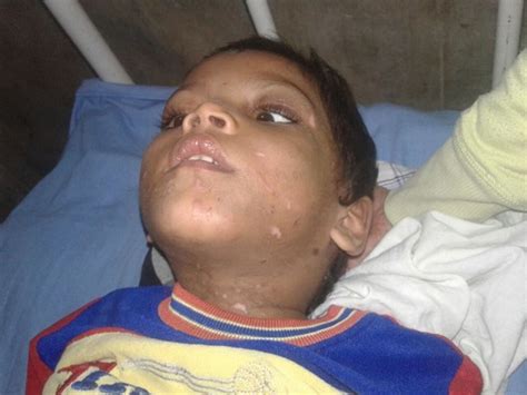 Banaskantha: cruel step mother gave burn scars to 4 year old dumb boy ...