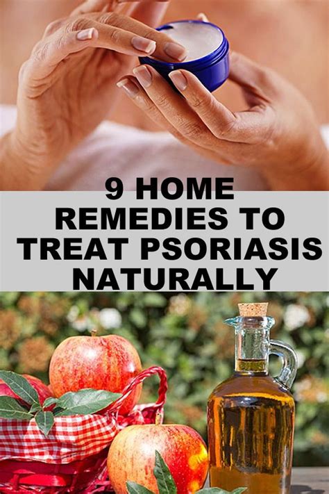 9 HOME REMEDIES TO TREAT PSORIASIS NATURALLY | Treat psoriasis, Natural ...