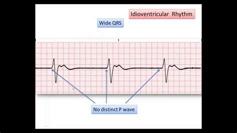 Ventricular Rhythm And Accelerated Ventricular Rhythm, 60% OFF