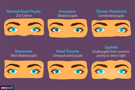 Pupil Size Chart Normal