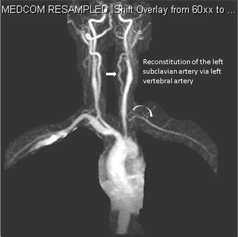 MRA demonstrating reconstitution of the left subclavian artery via left ...