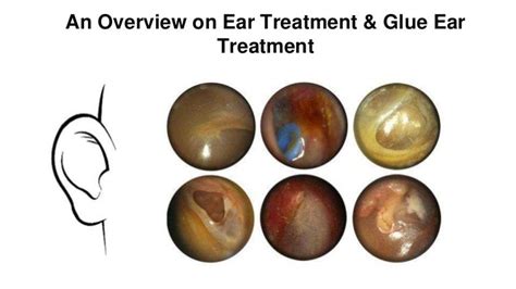 An overview on ear treatment & glue ear treatment