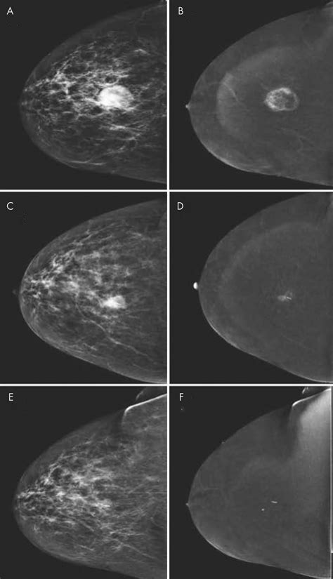 Contrast-enhanced Mammography: State of the Art | Radiology