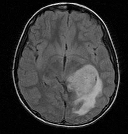 Pilocytic Astrocytoma- MRI Findings - Sumer's Radiology Blog