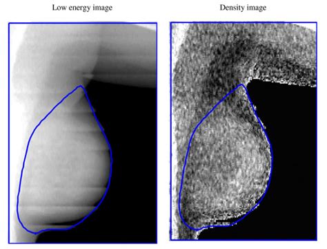 DXA breast images: Left breast of a girl (14 years, Tanner stage 5 ...