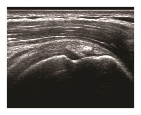 Ultrasound appearance of calcific tendinopathy. (a) Arc morphology ...