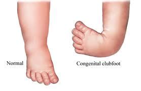 Talipes equinovarus - Types, Symptoms, Causes and Treatment