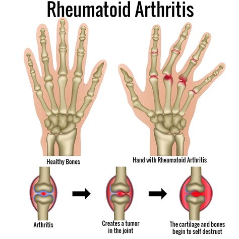 Rheumatoid Arthritis - Causes, Signs, Symptoms, Diet, Treatment