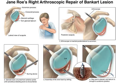 Bankart Lesion Repair | Behance :: Behance