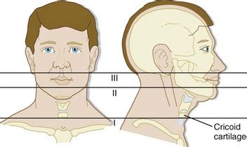 Penetrating Neck Trauma | Anesthesia Key