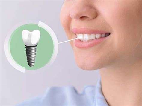 All on 4 Full Mouth Dental Implant in Rohini, Pitampura