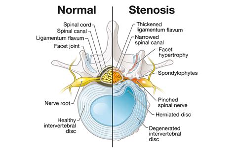 Lumbar Stenosis: Causes, Symptoms and Treatment Options for Narrowing ...