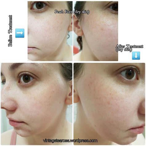 My Experience, Dermaplaning, Before & After Photos, Beauty Treatments ...