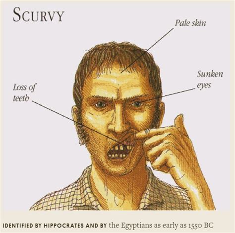 Scurvy-is-vitaminC-deficiency – Archer Dental