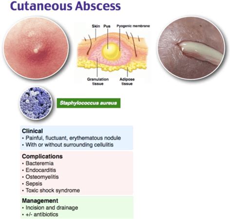 emDOCs.net – Emergency Medicine EducationEM@3AM: Abscess - emDOCs.net ...