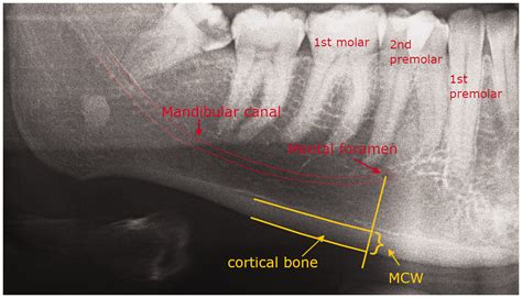 Mandibular Foramen Radiograph