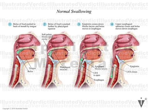 CASE AT A GLANCE: Partial Epiglottis Removal After Tongue Cancer ...