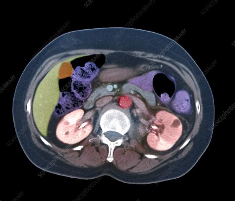 Pyelonephritis, axial CT scan - Stock Image - C047/4757 - Science Photo ...