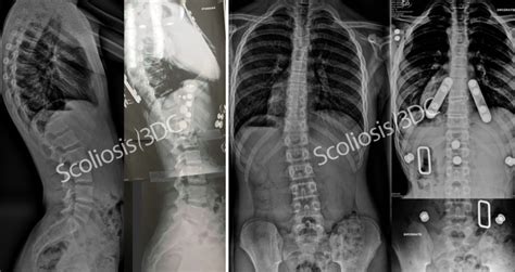 Kyphologic Brace | Kyphosis | Brace | Scheuermanns | Kyphoscoliosis