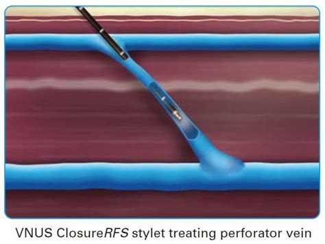 Vein & Vascular Treatment | Perforator Vein