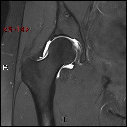 MRI Arthrogram Hip: Rule Out Labral Tear | Cedars-Sinai