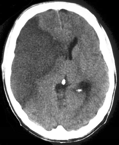 Acute infarct - Radiology at St. Vincent's University Hospital