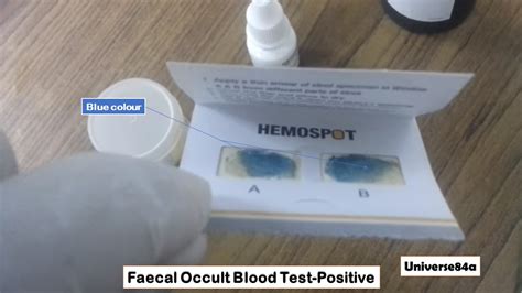 Faecal Occult Blood Test: Introduction, Principle, Procedure, Result Interp