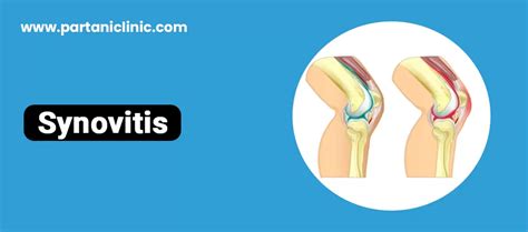 Knee Synovitis Treatment in Jaipur by Knee Arthoscopy Surgeon | Dr. Arun