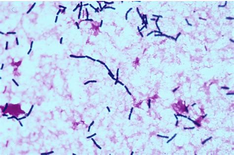 Persistent Bacillus cereus Bacteremia in an Immunocompetent Patient ...