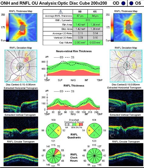 What is the OCT scan? - CE Hall Optometrists & Opticians