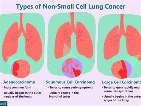 En segundo lugar Partido Colaborar con lung cancer medical term Conciso ...